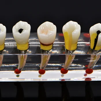 Endodontic patologické model patológia komunikácia medzi Pacientom a model Endodontic liečba Zadné Zuby, Zubné Buničiny Obnova